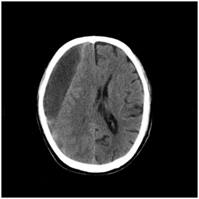 Chronic subdural hematoma that may be caused by nephrotic syndrome: a case report and literature review